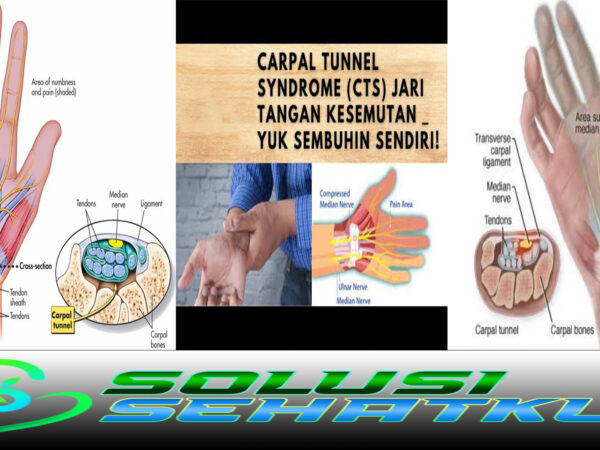 Ketahui 4 Penyebab Tangan Kanan Kesemutan
