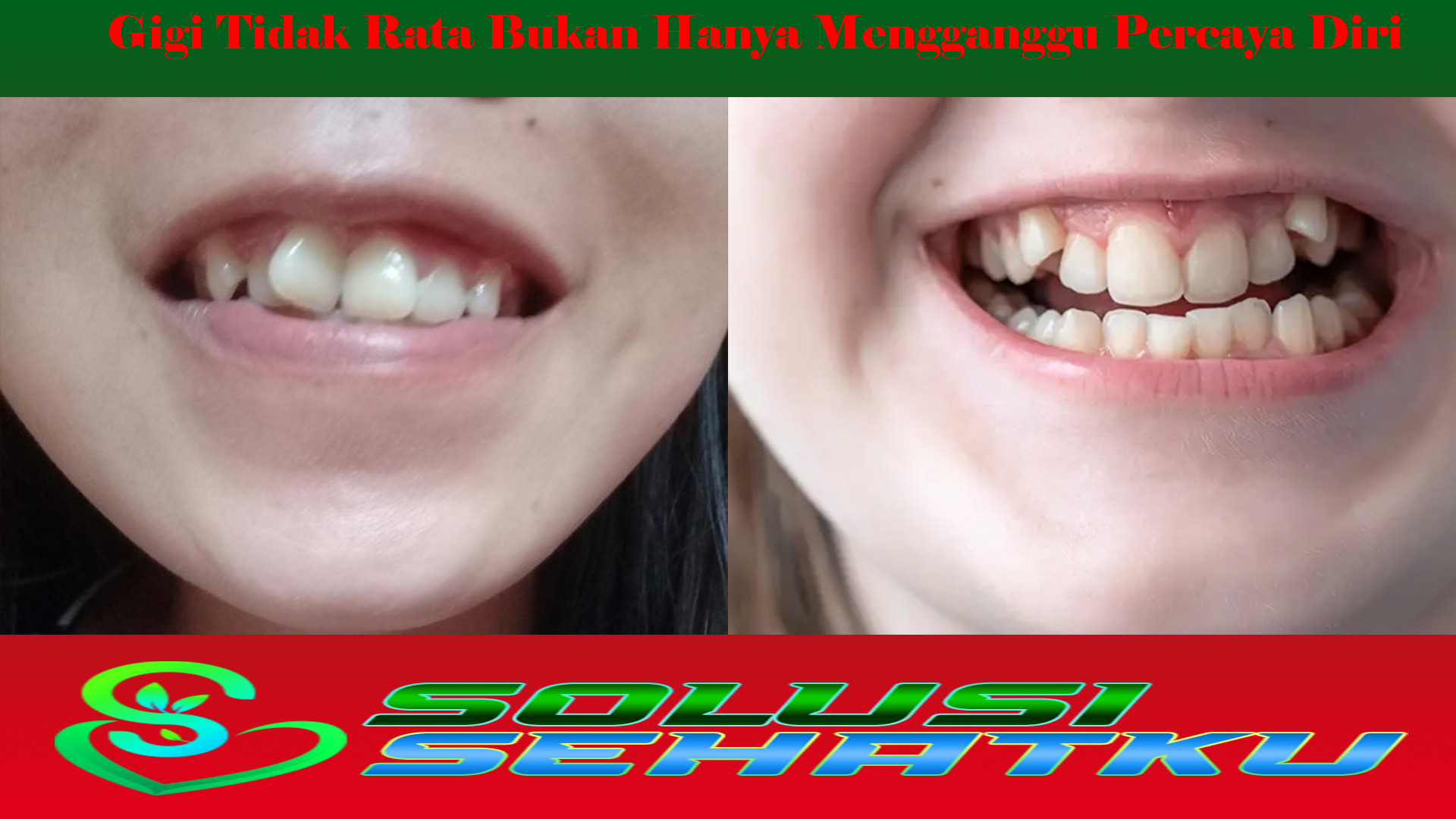 Gigi Tidak Rata Bukan Hanya Mengganggu Percaya Diri