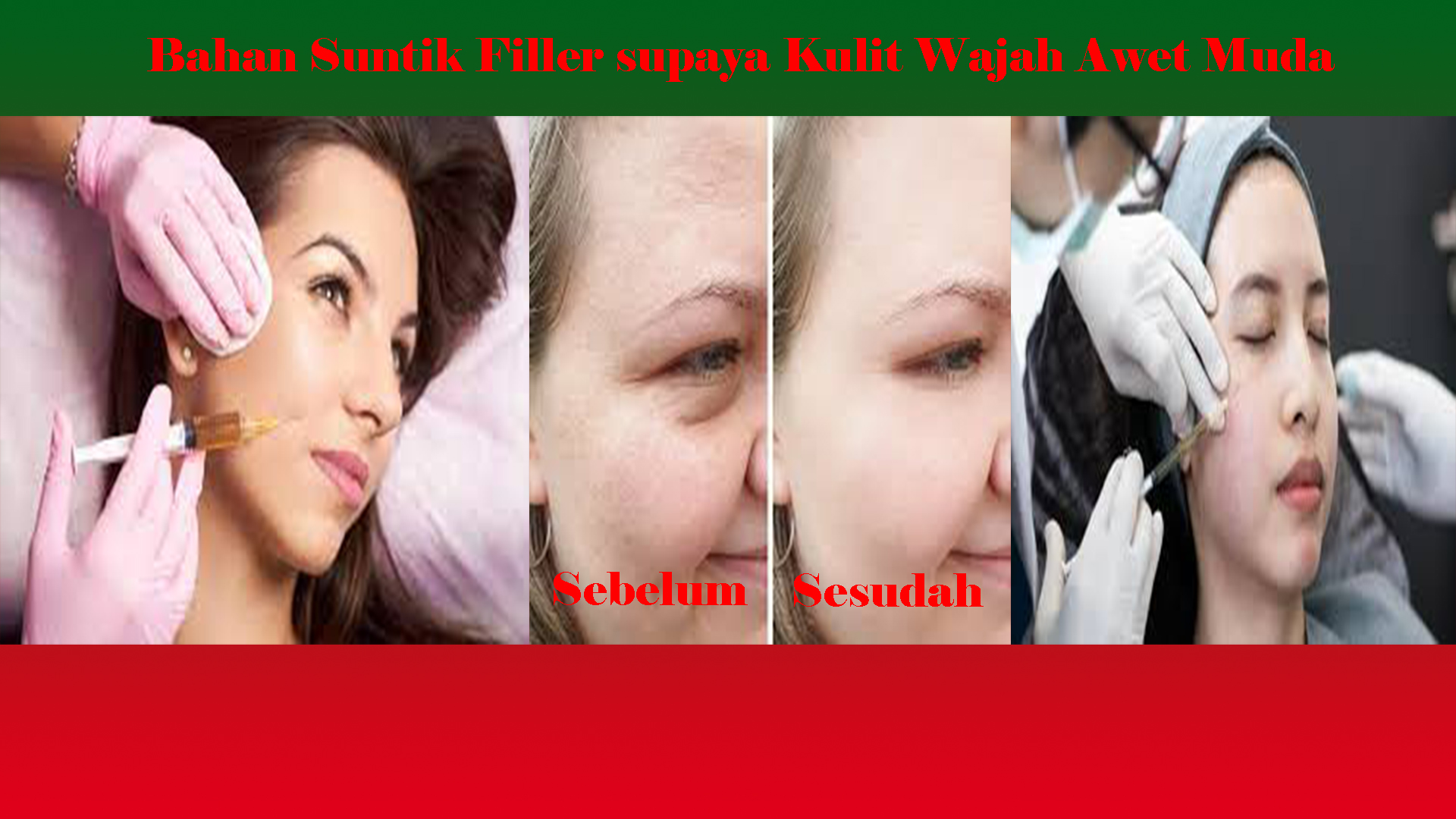 Bahan Suntik Filler supaya Kulit Wajah Awet Muda
