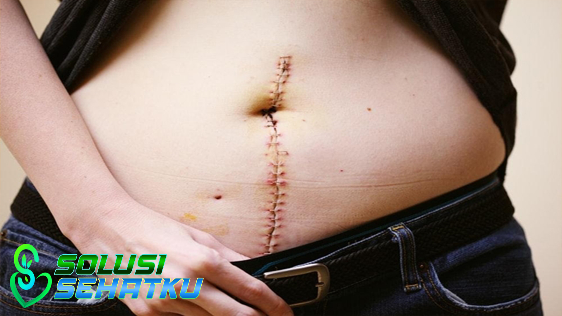 Cara Memudarkan Bekas Luka Operasi Caesar