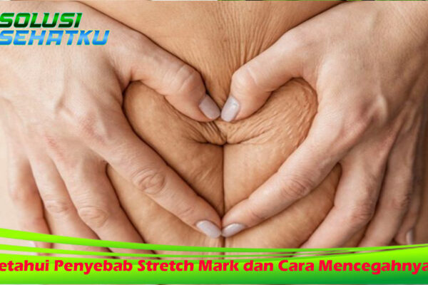 Ketahui Penyebab Stretch Mark dan Cara Mencegahnya