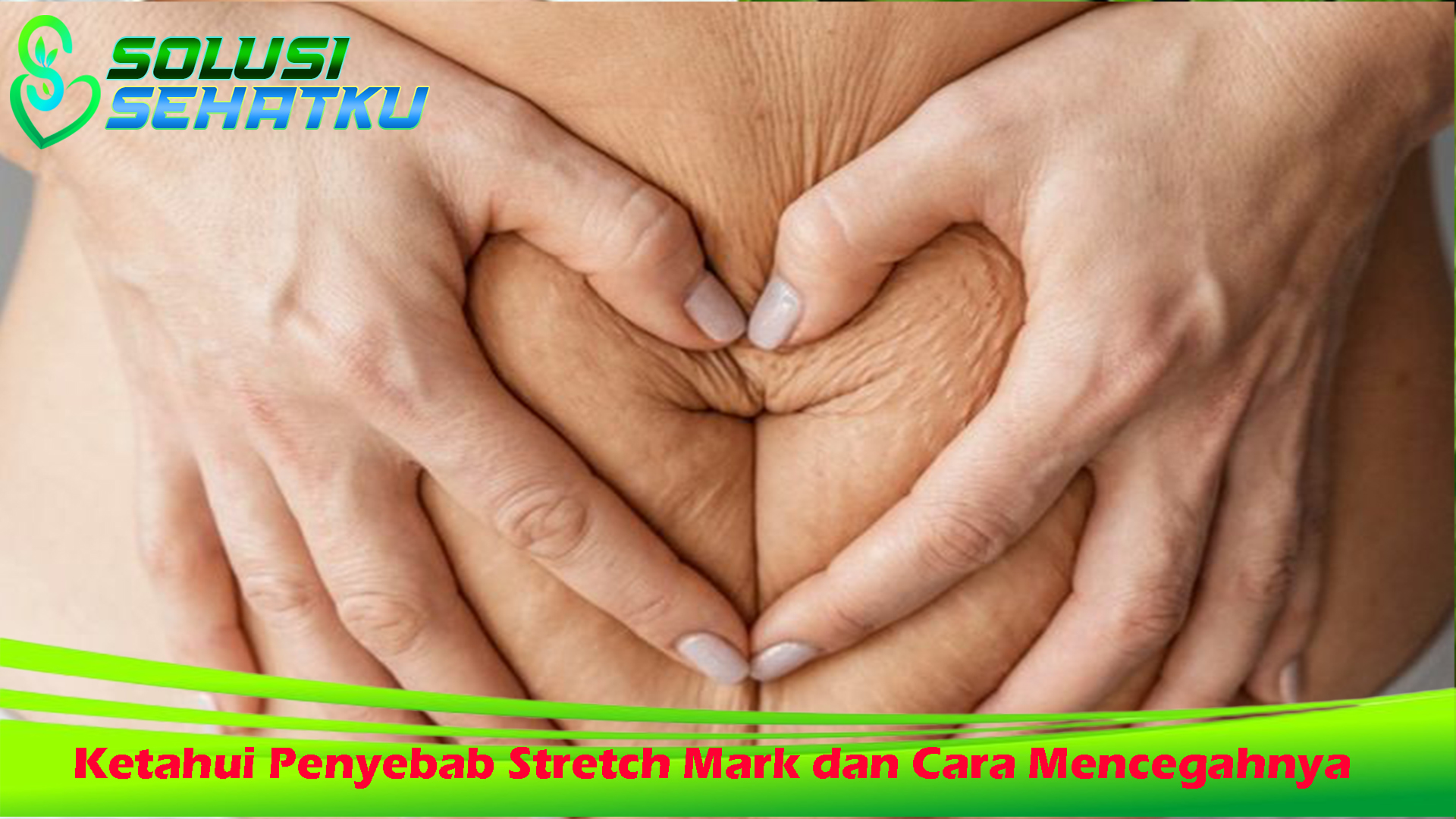 Ketahui Penyebab Stretch Mark dan Cara Mencegahnya