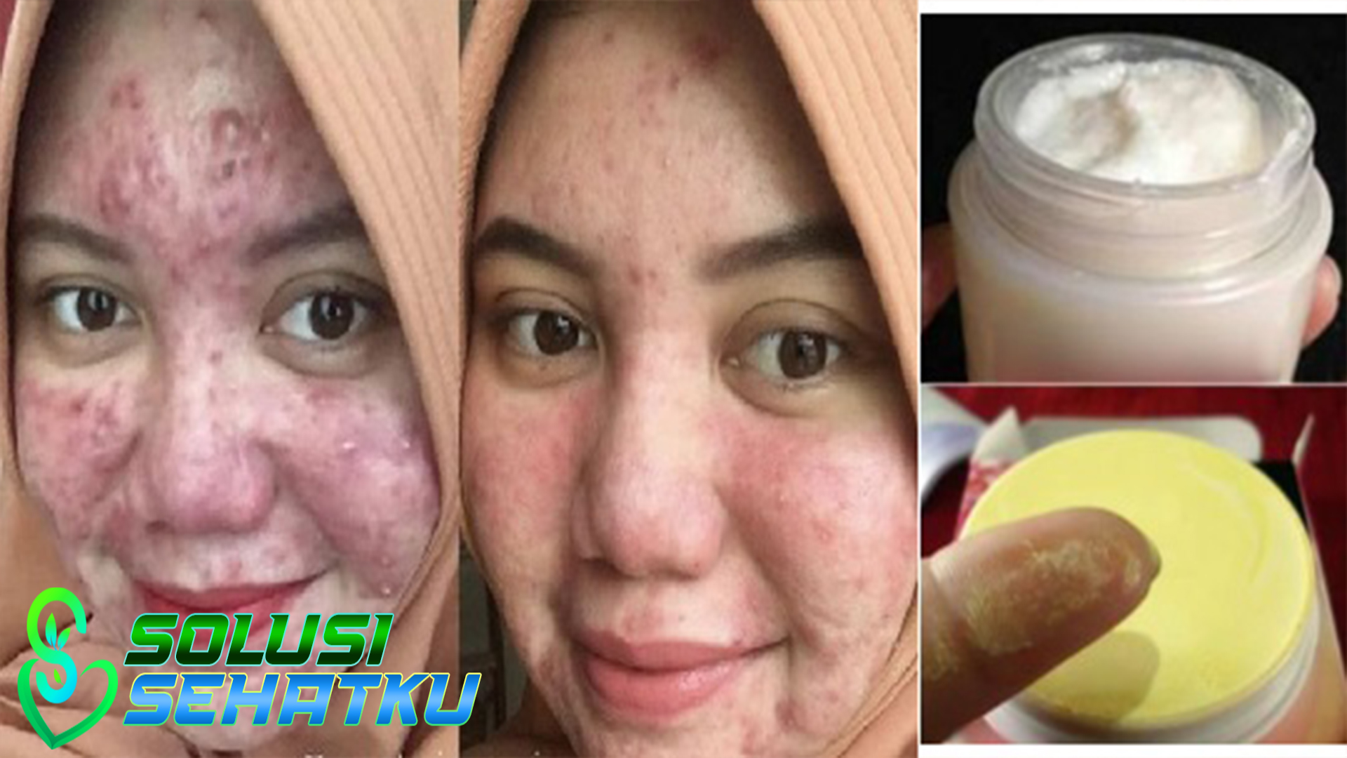 Ketahui Bahaya Pemutih Kulit Mengandung Merkuri