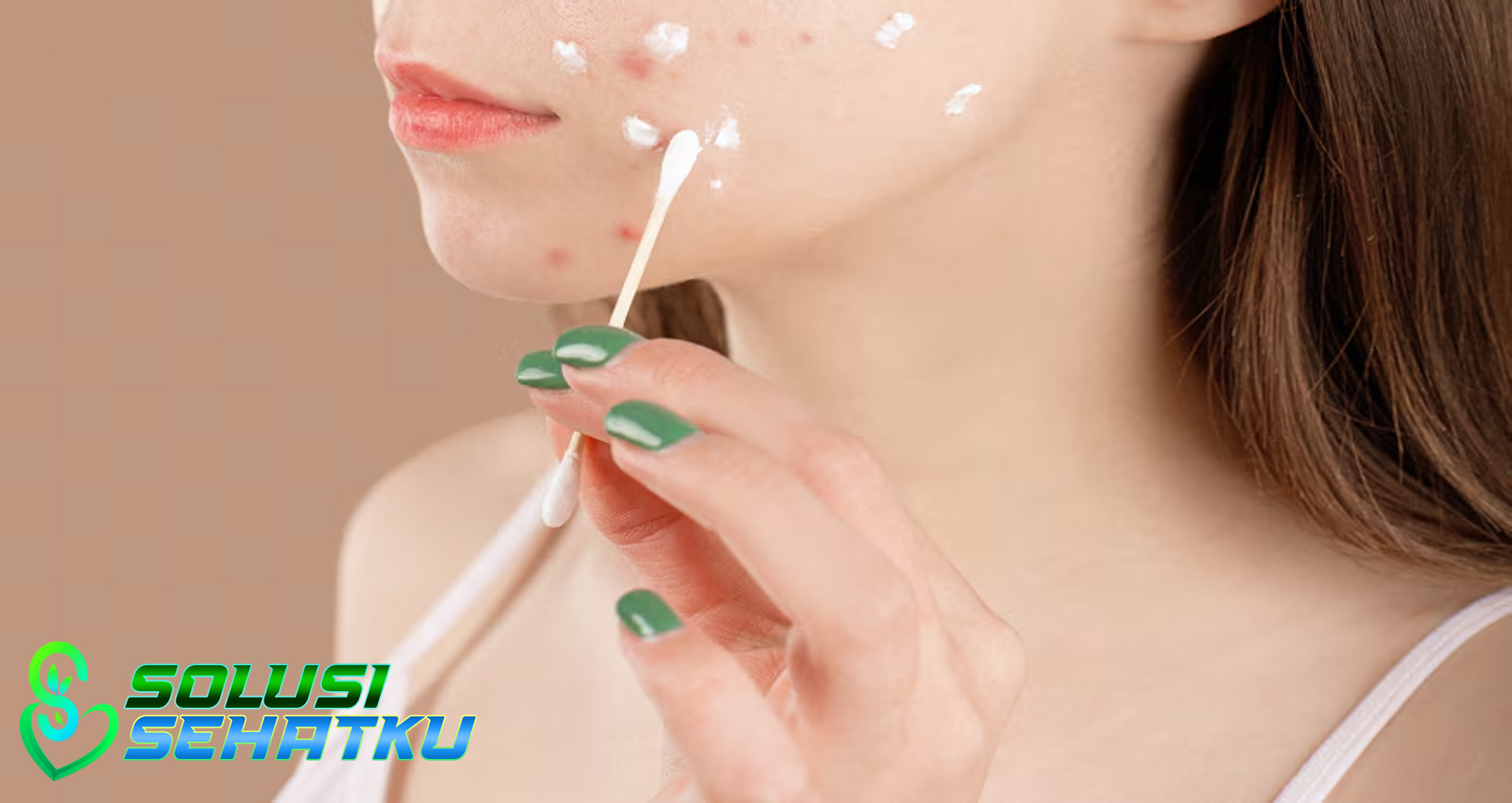 Salep Jerawat: Kenali Lebih Dekat 5 Kandungan di Dalamnya